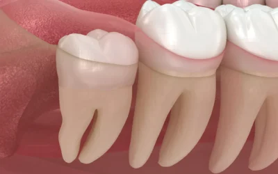 Betændelse i visdomstænder