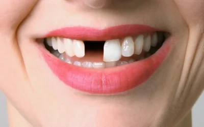 Har du slået en tand ud? Sådan behandles udslåede tænder